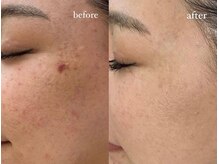 ラヴィス(RAVIS)/プロセルで悩み解決！