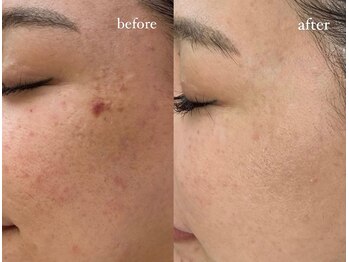 ラヴィス(RAVIS)/プロセルで悩み解決!