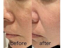 ディーキャットリー(D Catrry)/プラズマ光フェイシャル