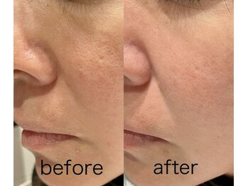 ディーキャットリー(D Catrry)/プラズマ光フェイシャル