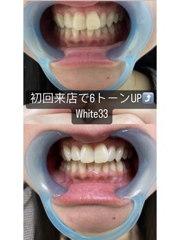 アイブロウ33 久留米店/【ホワイトニングBefore After】