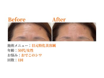 シルエラバレ(CiruelaValle)/Before After