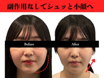 アロエベル(aloe Belle)/Before　After