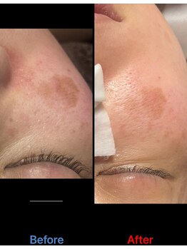 サロン ココ(COCO)/シミケア