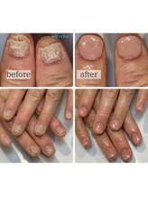 ティアラネイル 宇都宮/再発させない深爪矯正