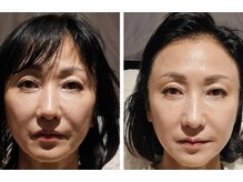 アン 銀座(ann)/レモンボトル&エクソソーム