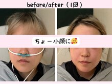 ヨサパーク ベアトリーチェ(YOSA PARK beatrice)/水素吸入で小顔に！