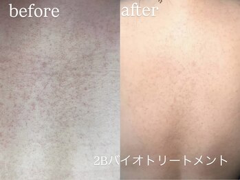 エーアール(ar)/ハーブピーリング/2Bバイオ