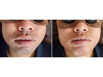 メンズ脱毛サロン アカラ(AKALA)/ヒゲのビフォーアフター