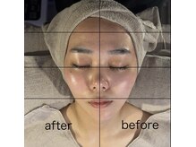 サナン(SANAN)の雰囲気（話題の脂肪分解レモンボトル施術！即効で得られるこの効果！）