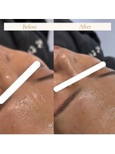 ディアー(Dear)/スキンジェクションプロ