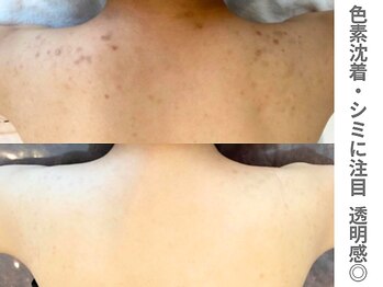 ピュアノア 三木店/背中ピーリング　三木|小野|西脇