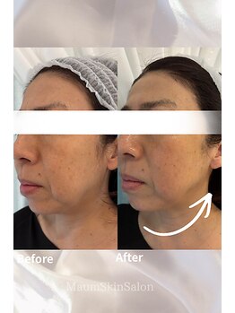 マウム(Maum)/リフトアップ・たるみケア