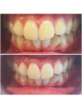 エクシアホワイトニング 代々木店/ホワイトニングビフォーアフター