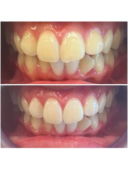 エクシアホワイトニング 代々木店/ホワイトニングビフォーアフター