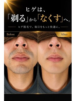 ムダ毛ゼロ番地の写真/剃っても残る青ヒゲにメンズの新常識★