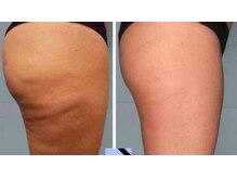 ツバキ(TSUBAKI)/凸凹肌がなめらかに！