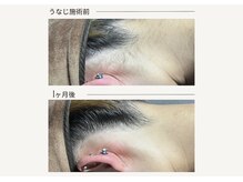 クレビア(CREVIA)/Lady's襟足脱毛◆BeforeAfter