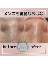 メイト(mate)/毛穴エクストラクションtete式