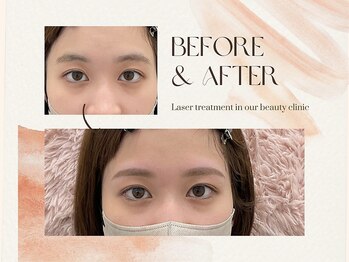 ナキ 富山店(Naki)/眉毛施術例 (眉毛Before.After)