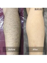 エヌーサ(Enoosa)/☆男性美肌脱毛☆