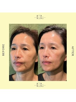 ティエドゥール エム(tiedeur × EMU)/エクソリフト