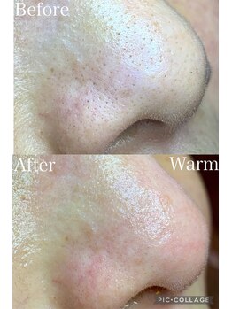 ウォーム(Warm)/40代女性毛穴エクストラクション