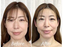 ドクターボディ 新宿店(Dr.Body)/【面長/左右差/たるみ改善40代】