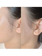 チュルリ 新町店(Chururi)/もみあげ/もみあげワックス脱毛