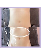 エクラ 天神店(ecla)/腸活、ウエストシェイプ