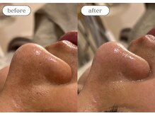 リスタ(RSTA)/【BEFORE/AFTER】