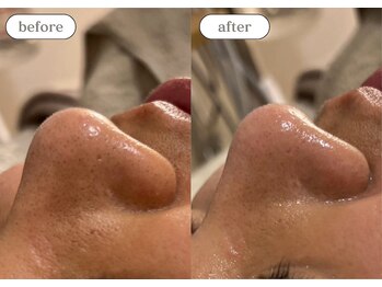 リスタ(RSTA)/【BEFORE/AFTER】