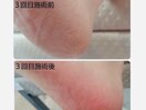 フット角質ケア