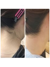 ラピス(Lapis)/うなじワックス脱毛！