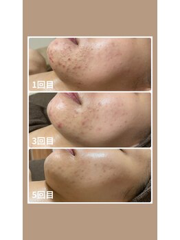 ホリホック/症例