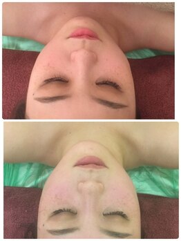 アロマリエ(al malie)/ラジオ波小顔