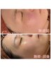 6,500円OFF♪都度払い【シミケア20分当て放題】＋ハイドラ毛穴洗浄☆10,280円