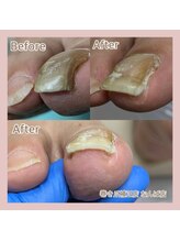 巻き爪補正店 大阪なんば店/巻き爪補正 &nbsp;2箇所