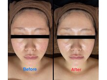 ビタミンスパ 中野店/美肌★施術回数1回