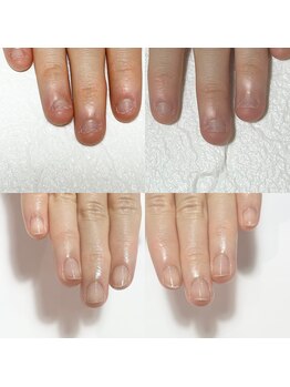 キュア(Cure.)/噛む癖の深爪緩和