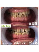 ルブラン 奈良店(Le Blanc)/ホワイトニングに年齢は関係無！