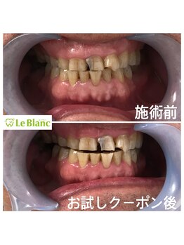 ルブラン 奈良店(Le Blanc)/ホワイトニングに年齢は関係無！