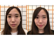 アイユーサロン(愛YOUsalon)/小顔矯正