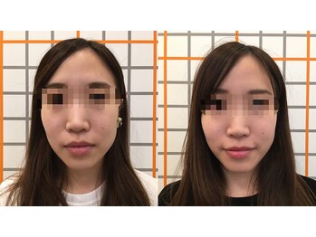 アイユーサロン(愛YOUsalon)/小顔矯正