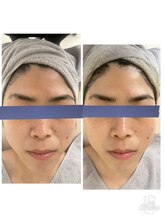 リッチベル(richbelle)/ハーブピーリング　初回