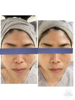 リッチベル(richbelle)/ハーブピーリング 初回