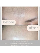 シュガーリングハウスレディ(SugaringHouse LADY)/フェイシャルシュガーリング