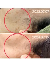 シシラ(shishira)/シミケアで年齢肌にさよなら～