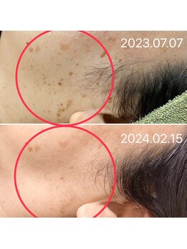 シシラ(shishira)/シミケアで年齢肌にさよなら～