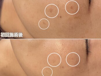 ベルエクラ(Bel Eclat)/シミBeforeAfter/那覇